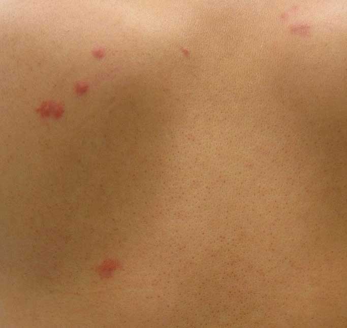 what do bed bug bites look like