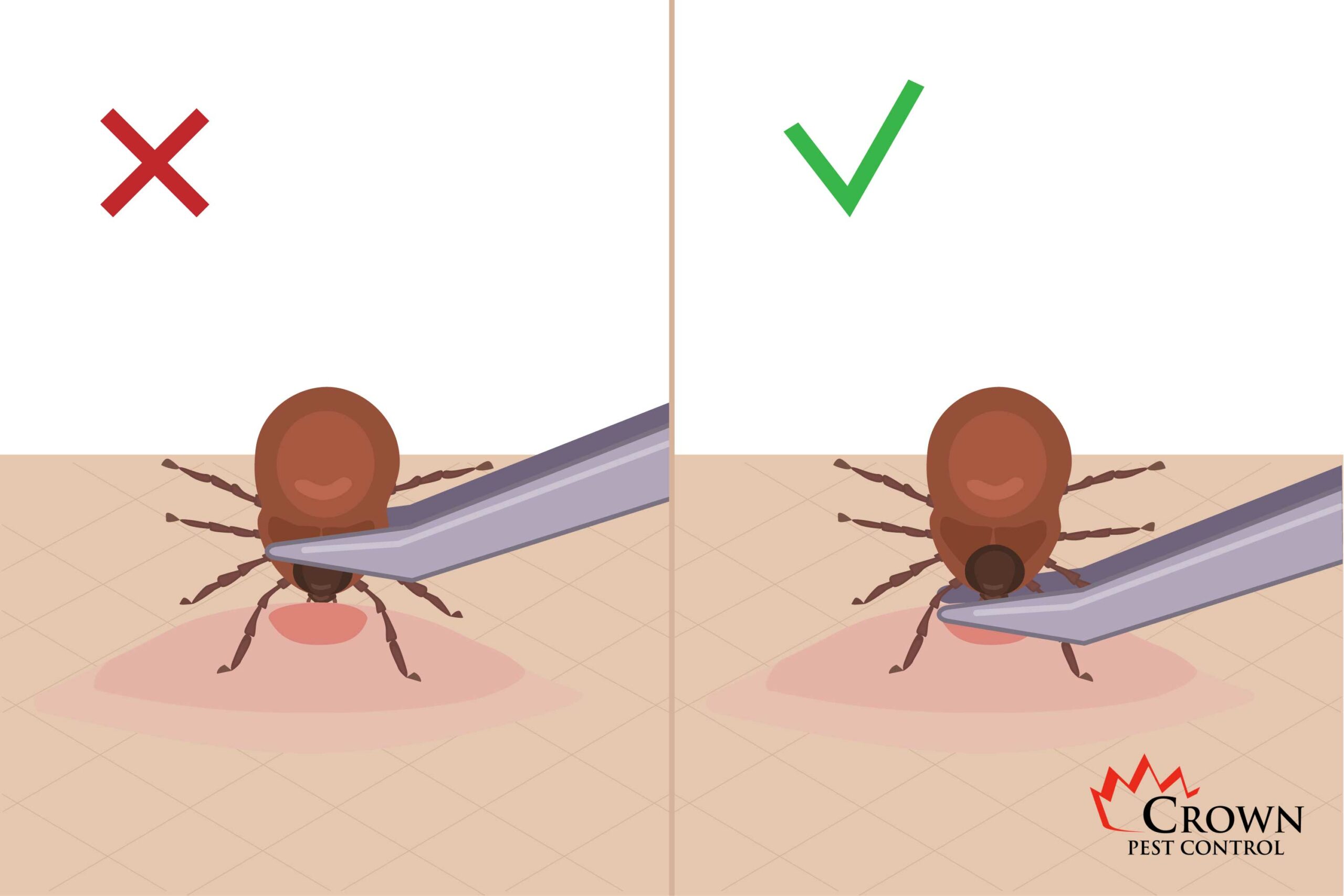 tick removal